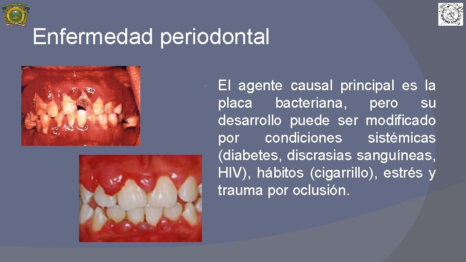 Enfermedad periodontal El agente causal principal es la placa bacteriana, pero su desarrollo puede
