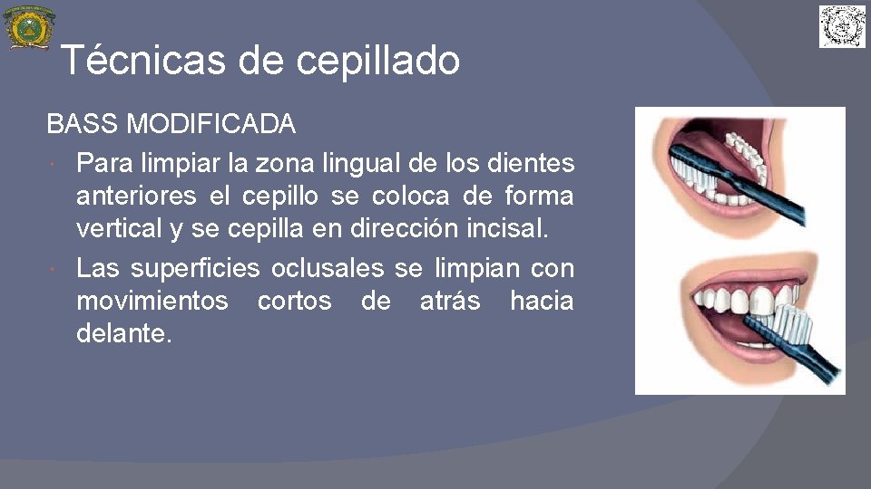 Técnicas de cepillado BASS MODIFICADA Para limpiar la zona lingual de los dientes anteriores