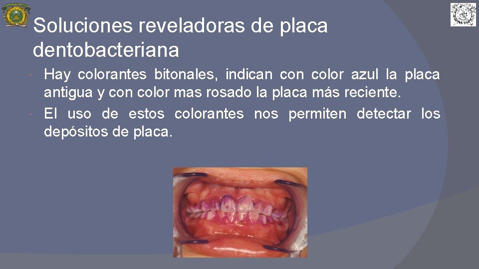 Soluciones reveladoras de placa dentobacteriana Hay colorantes bitonales, indican color azul la placa antigua