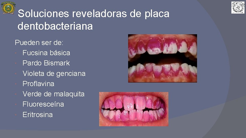 Soluciones reveladoras de placa dentobacteriana Pueden ser de: Fucsina básica Pardo Bismark Violeta de