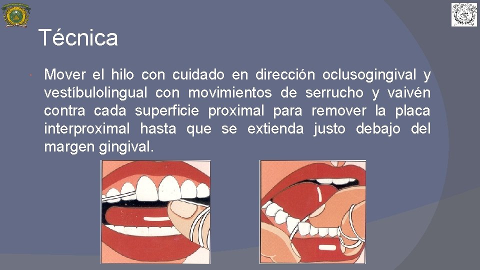 Técnica Mover el hilo con cuidado en dirección oclusogingival y vestíbulolingual con movimientos de