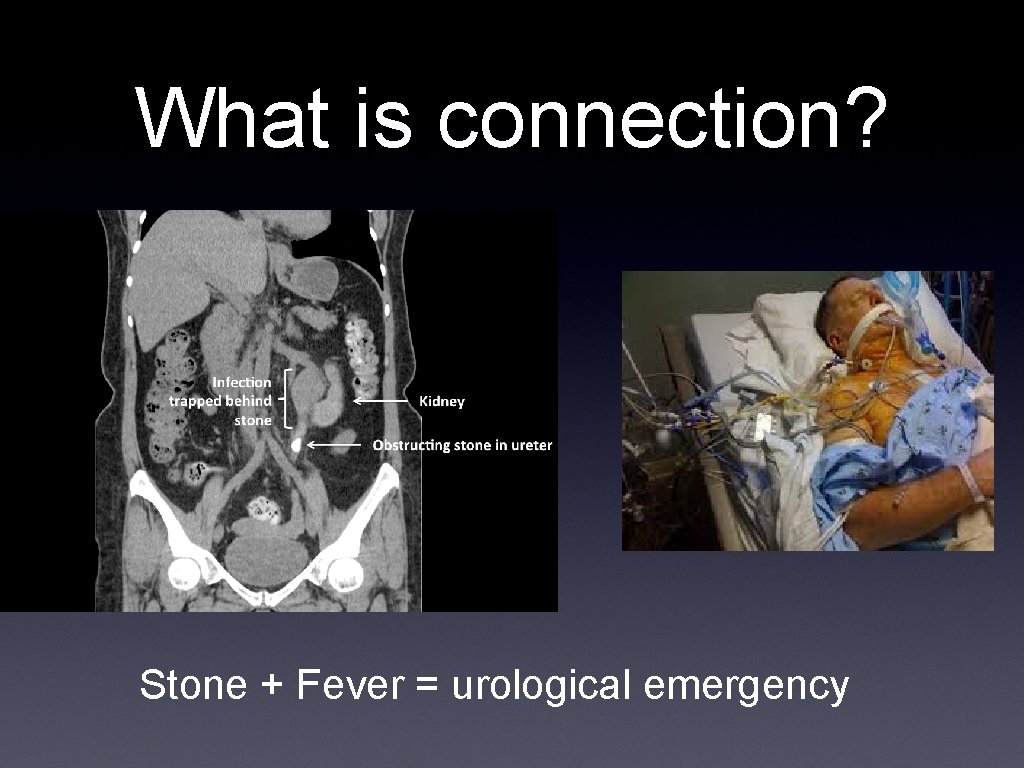 What is connection? Stone + Fever = urological emergency 