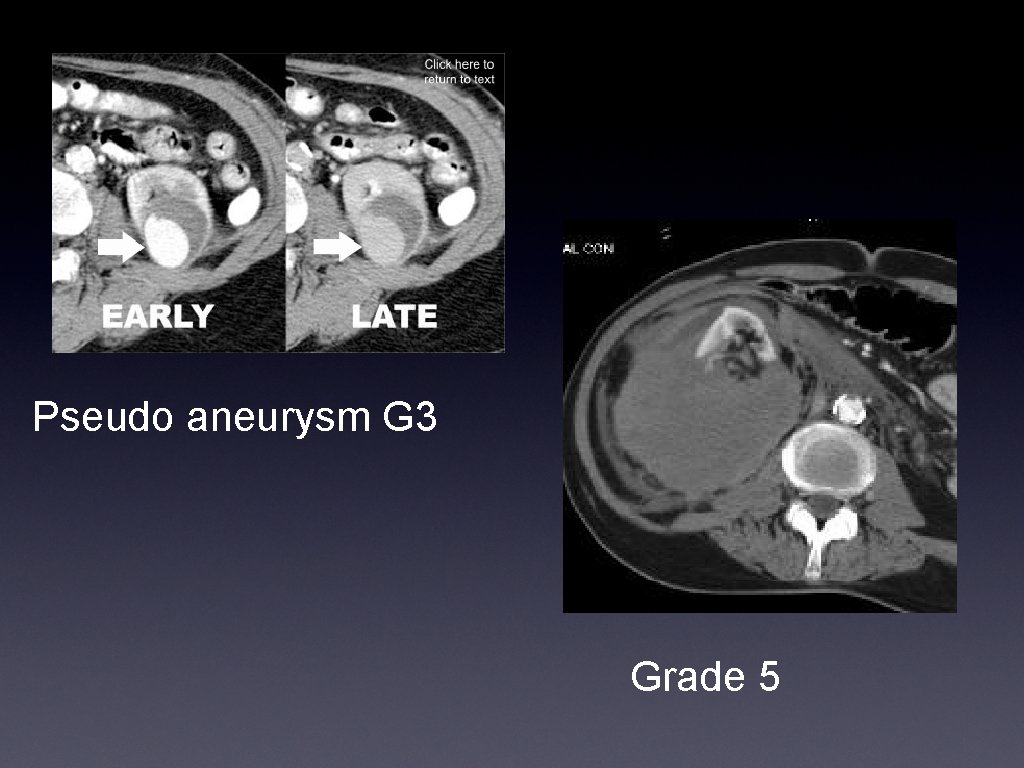 Pseudo aneurysm G 3 Grade 5 
