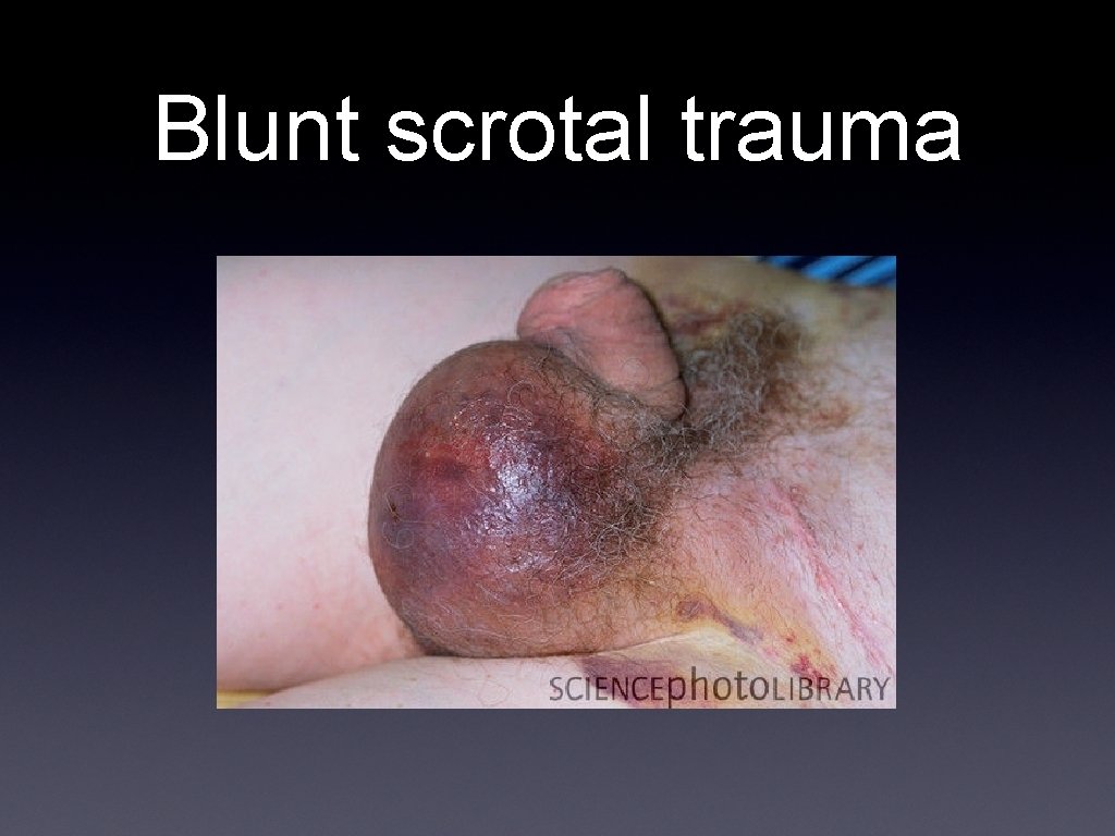 Blunt scrotal trauma 