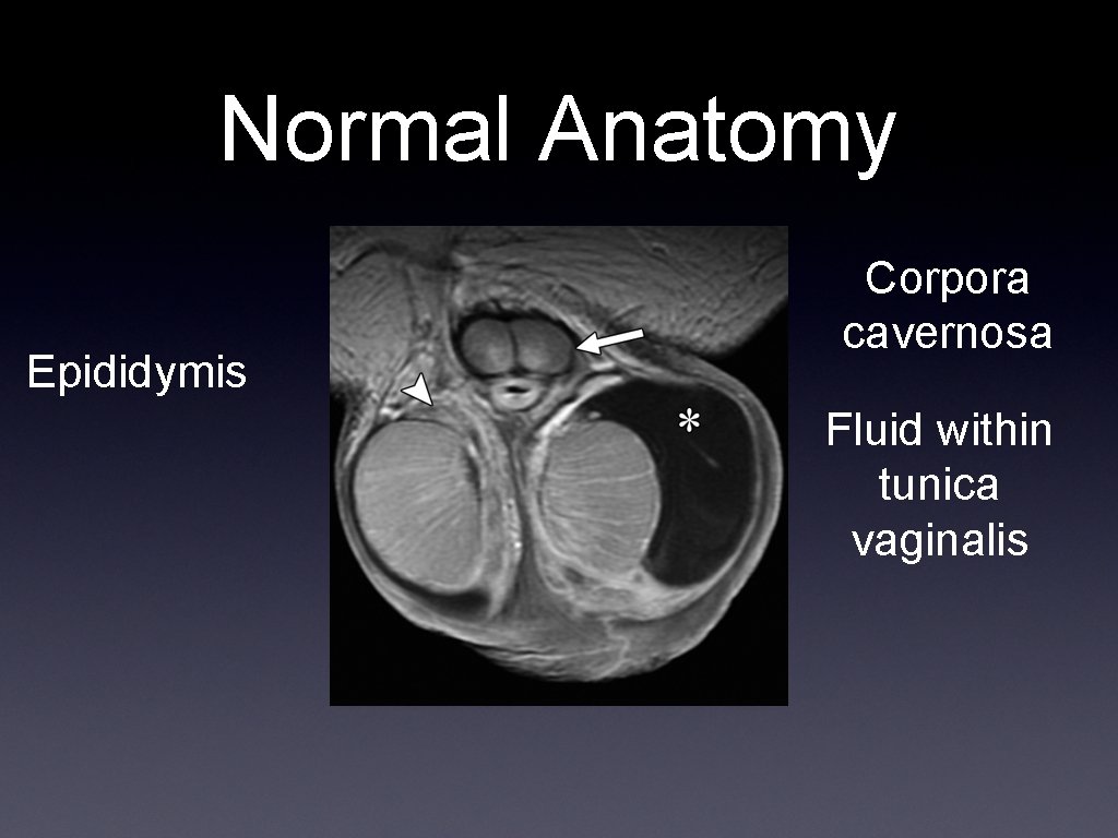 Normal Anatomy Epididymis Corpora cavernosa Fluid within tunica vaginalis 