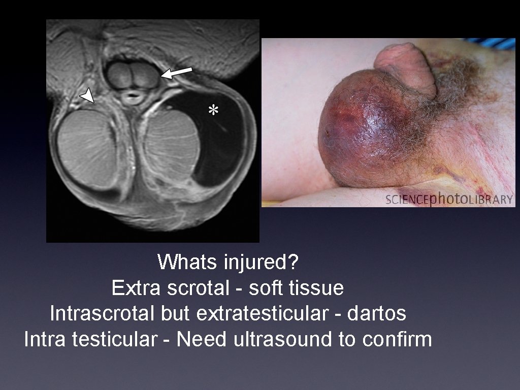 Whats injured? Extra scrotal - soft tissue Intrascrotal but extratesticular - dartos Intra testicular