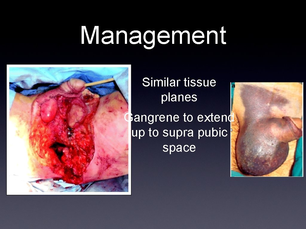 Management Similar tissue planes Gangrene to extend up to supra pubic space 