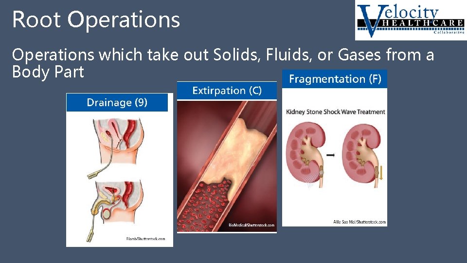 Root Operations which take out Solids, Fluids, or Gases from a Body Part 