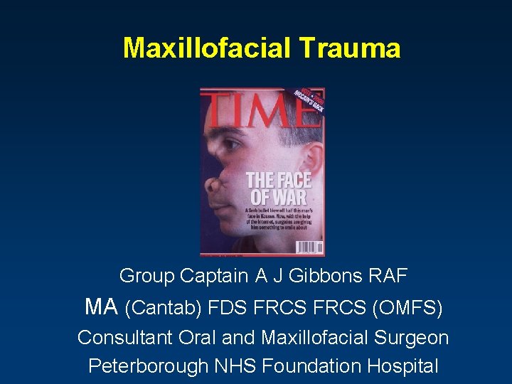 Maxillofacial Trauma Group Captain A J Gibbons RAF MA (Cantab) FDS FRCS (OMFS) Consultant