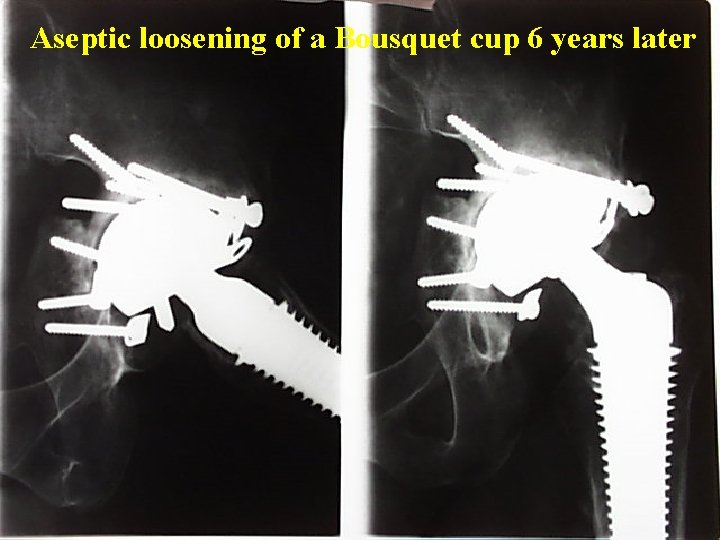 Aseptic loosening of a Bousquet cup 6 years later 