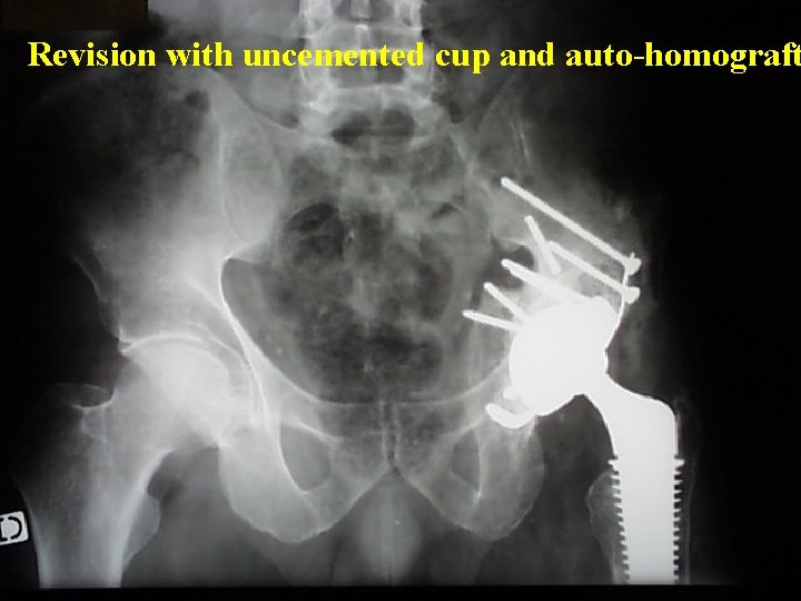 Revision with uncemented cup and auto-homograft 