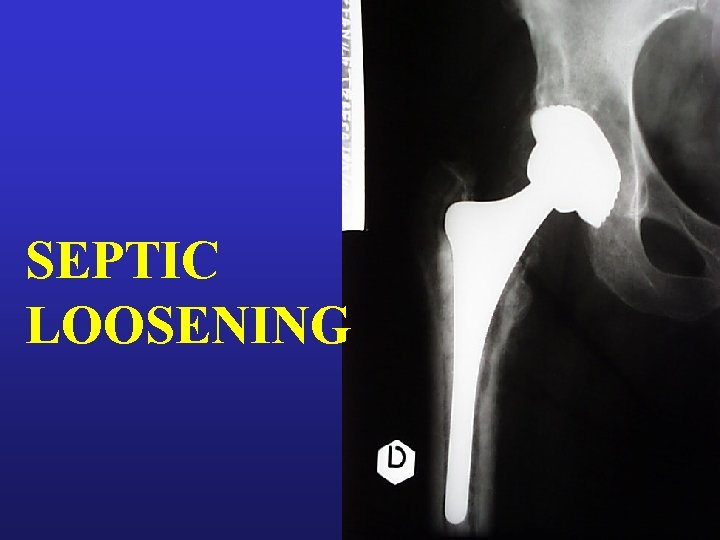 SEPTIC LOOSENING 