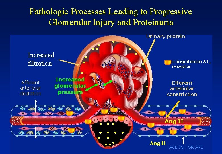 Pathologic Processes Leading to Progressive Glomerular Injury and Proteinuria Urinary protein Increased filtration Afferent