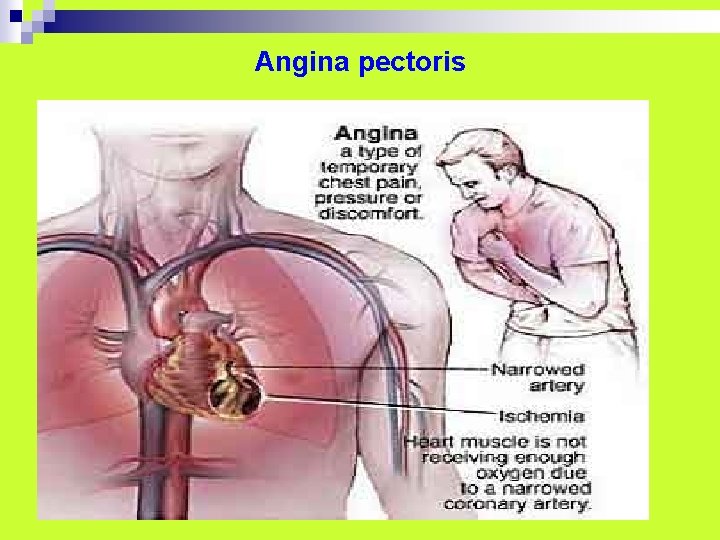 Angina pectoris Angina pectoris