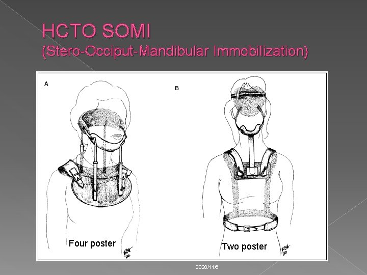 HCTO SOMI (Stero-Occiput-Mandibular Immobilization) Four poster Two poster 2020/11/6 