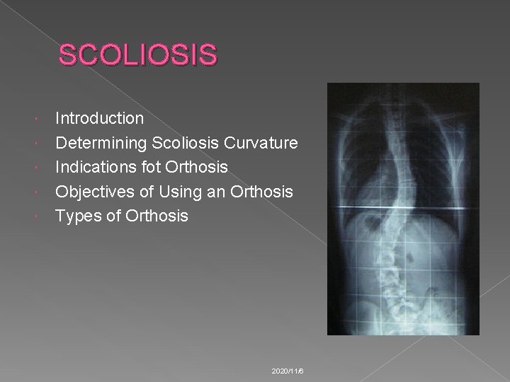 SCOLIOSIS Introduction Determining Scoliosis Curvature Indications fot Orthosis Objectives of Using an Orthosis Types