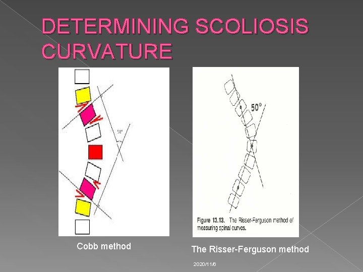 DETERMINING SCOLIOSIS CURVATURE Cobb method The Risser-Ferguson method 2020/11/6 
