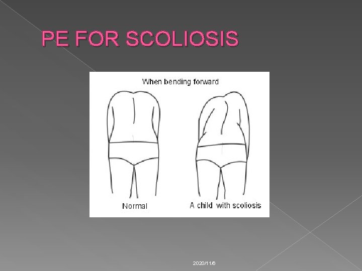 PE FOR SCOLIOSIS 2020/11/6 