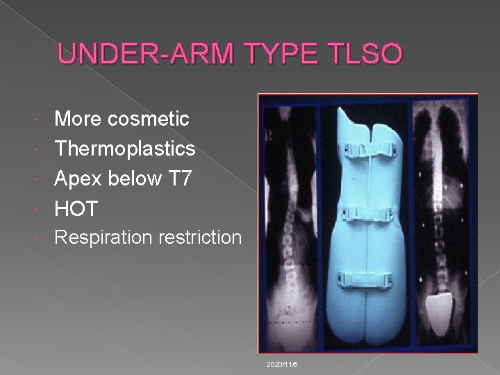 UNDER-ARM TYPE TLSO More cosmetic Thermoplastics Apex below T 7 HOT Respiration restriction 2020/11/6