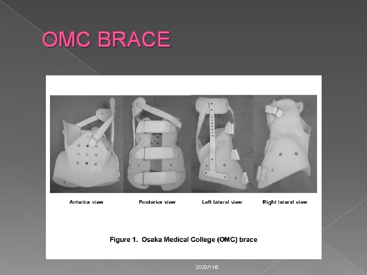 OMC BRACE 2020/11/6 