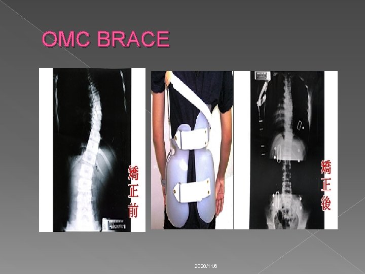 OMC BRACE 2020/11/6 