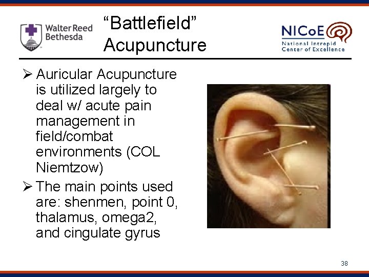 “Battlefield” Acupuncture Ø Auricular Acupuncture is utilized largely to deal w/ acute pain management