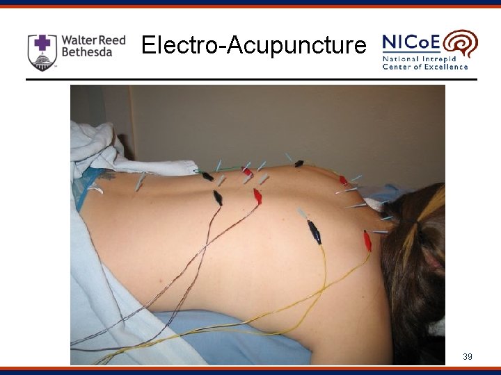 Electro-Acupuncture 39 