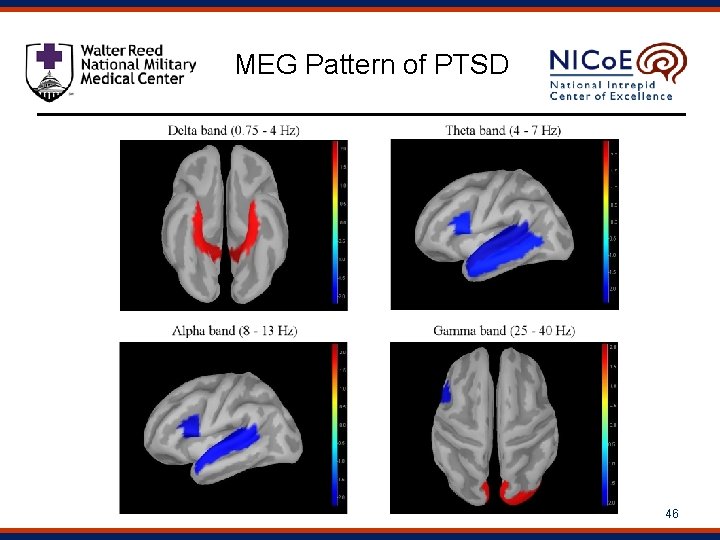 MEG Pattern of PTSD 46 46 