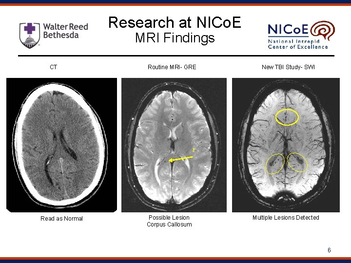 Research at NICo. E MRI Findings CT Routine MRI- GRE New TBI Study- SWI
