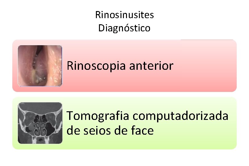 Rinosinusites Diagnóstico Rinoscopia anterior Tomografia computadorizada de seios de face 