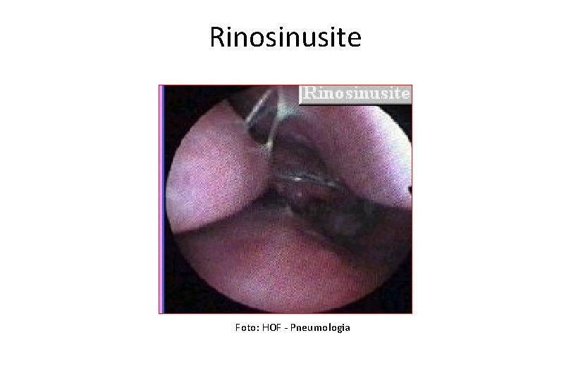 Rinosinusite Foto: HOF - Pneumologia 