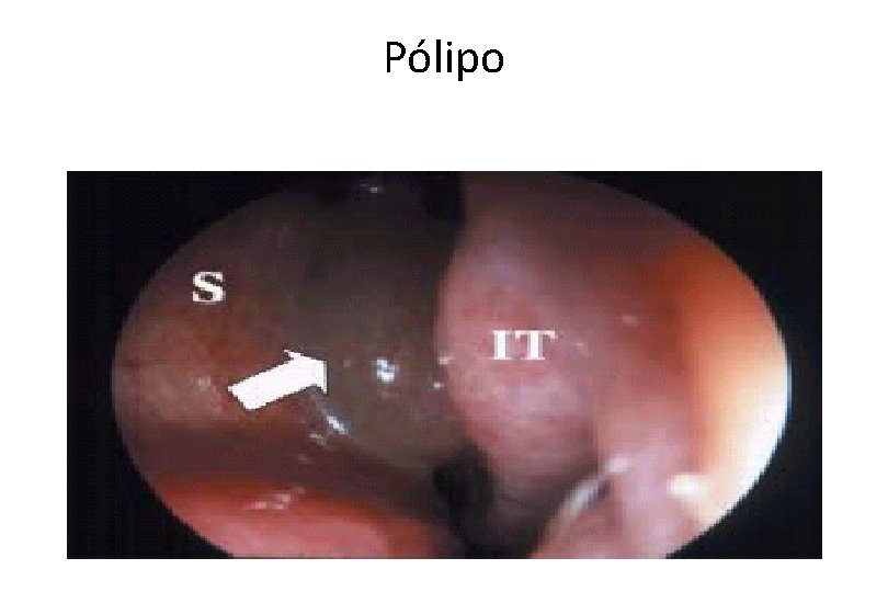 Pólipo 