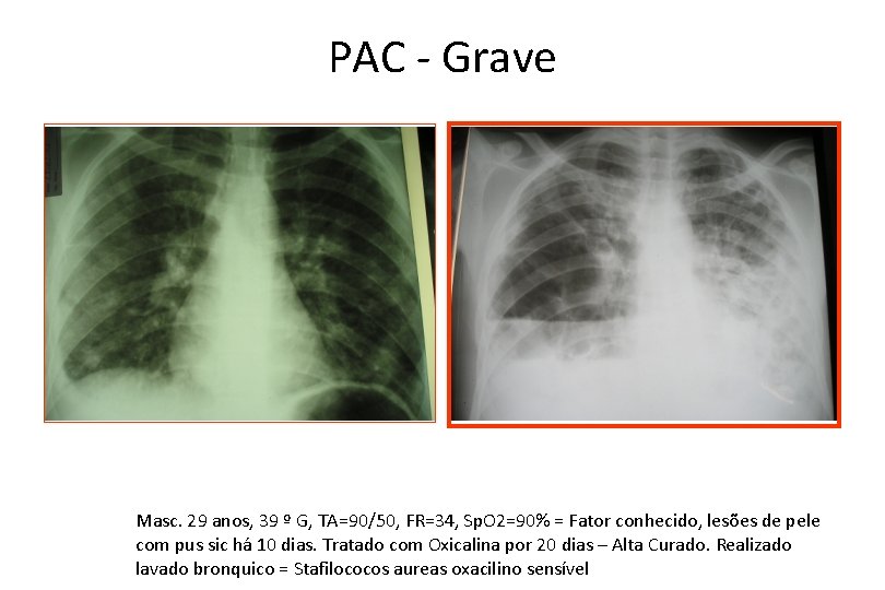 PAC - Grave Masc. 29 anos, 39 º G, TA=90/50, FR=34, Sp. O 2=90%