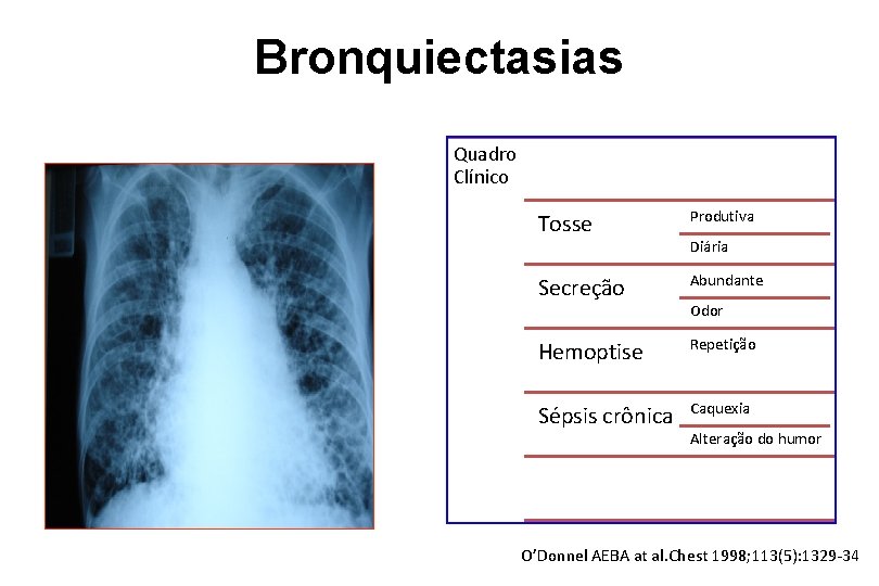 Bronquiectasias Quadro Clínico Tosse Produtiva Secreção Abundante Hemoptise Repetição Sépsis crônica Caquexia Diária Odor