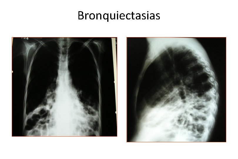 Bronquiectasias 