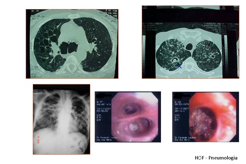 HOF - Pneumologia 
