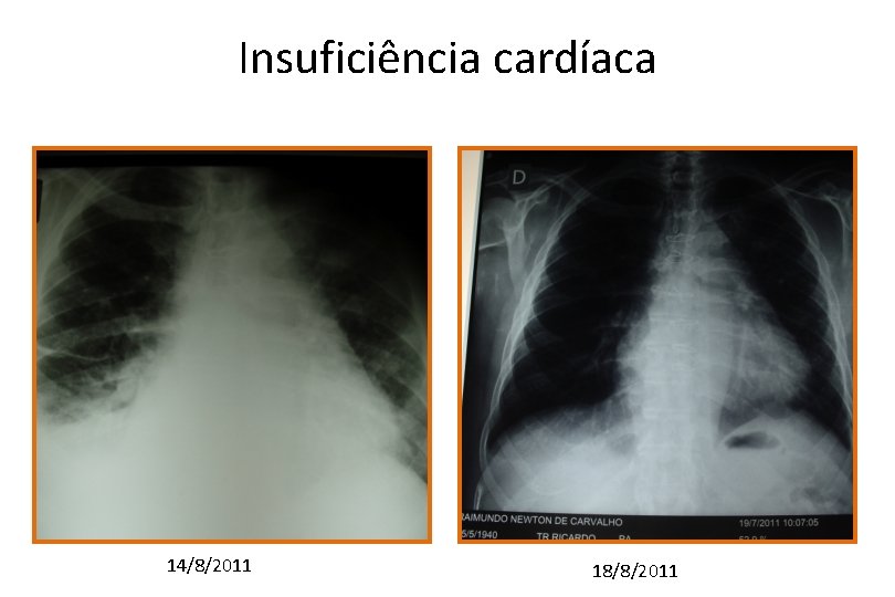 Insuficiência cardíaca 14/8/2011 18/8/2011 