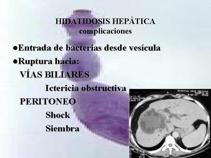 HIDATIDOSIS HEPÁTICA complicaciones l. Entrada de bacterias desde vesícula l. Ruptura hacia: VÍAS BILIARES