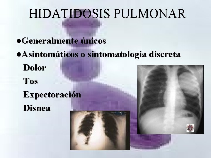 HIDATIDOSIS PULMONAR l. Generalmente únicos l. Asintomáticos o sintomatología discreta Dolor Tos Expectoración Disnea