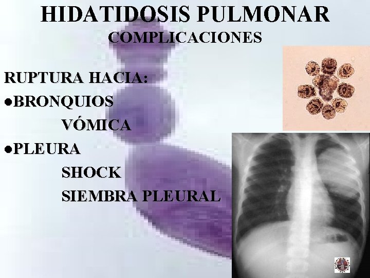 HIDATIDOSIS PULMONAR COMPLICACIONES RUPTURA HACIA: l. BRONQUIOS VÓMICA l. PLEURA SHOCK SIEMBRA PLEURAL 