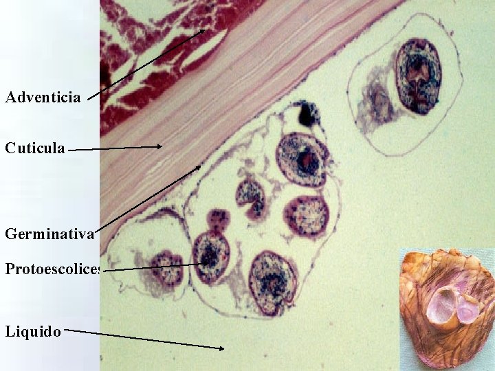 Adventicia Cuticula Germinativa Protoescolices Liquido 
