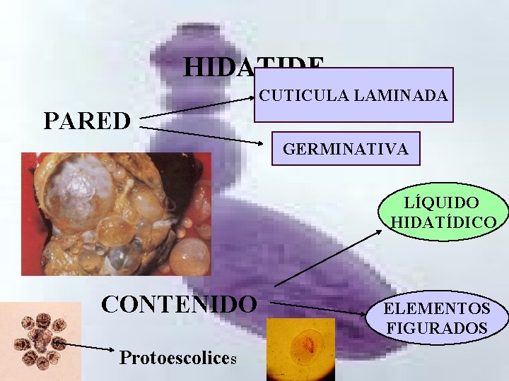 HIDATIDE CUTICULA LAMINADA PARED GERMINATIVA LÍQUIDO HIDATÍDICO CONTENIDO Protoescolices ELEMENTOS FIGURADOS 