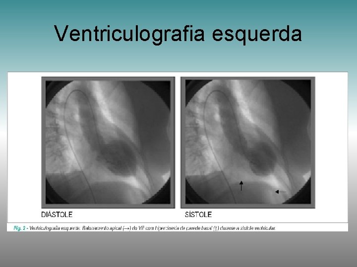 Ventriculografia esquerda 