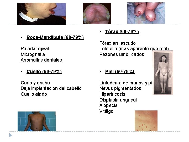  • Tórax (60 -79%) • Boca-Mandíbula (60 -79%) Paladar ojival Micrognatia Anomalías dentales