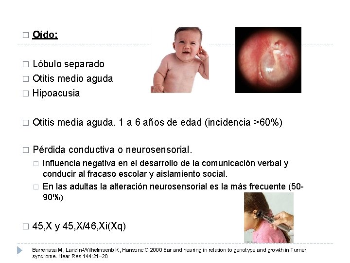 � Oído: Lóbulo separado � Otitis medio aguda � Hipoacusia � � Otitis media