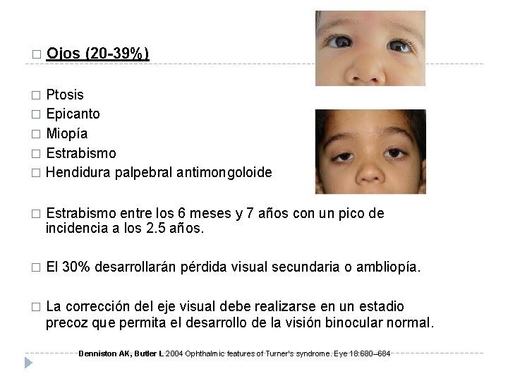 � Ojos (20 -39%) Ptosis � Epicanto � Miopía � Estrabismo � Hendidura palpebral