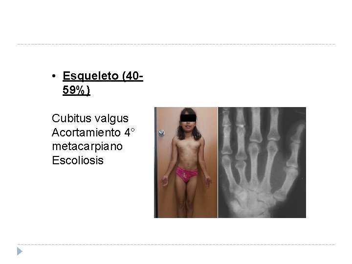 • Esqueleto (4059%) Cubitus valgus Acortamiento 4° metacarpiano Escoliosis 
