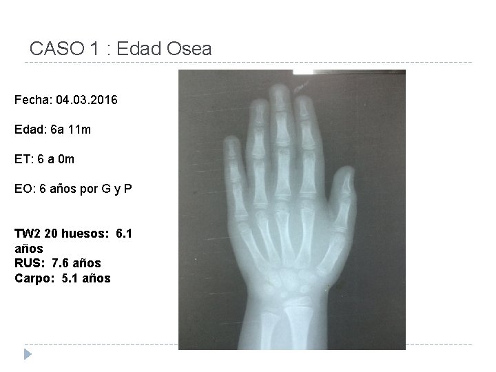 CASO 1 : Edad Osea Fecha: 04. 03. 2016 Edad: 6 a 11 m