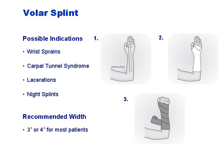 Volar Splint Possible Indications 2. 1. • Wrist Sprains • Carpal Tunnel Syndrome •