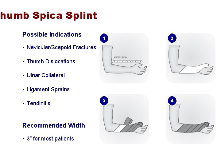Thumb Spica Splint Possible Indications 1 2 3 4 • Navicular/Scapoid Fractures • Thumb